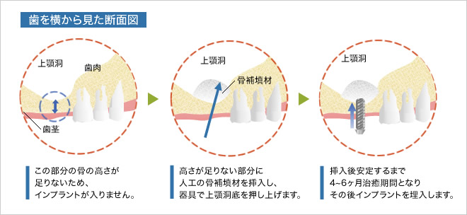 歯を横から見た断面図