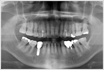 一本だけインプラントを入れた歯のレントゲン写真