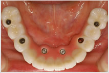 下の歯茎に6本のインプラント　歯を被せた後の写真