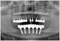 下の歯茎に6本のインプラント　レントゲン写真