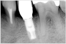 抜けかけた歯の横にインプラントを埋入したレントゲン写真
