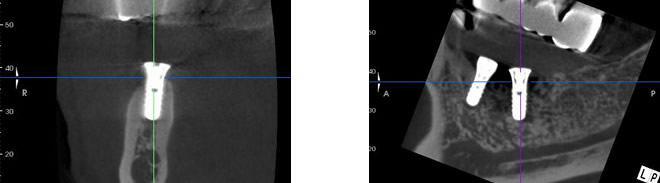 インプラントのCT画像
