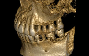 歯周病治療CTイメージ
